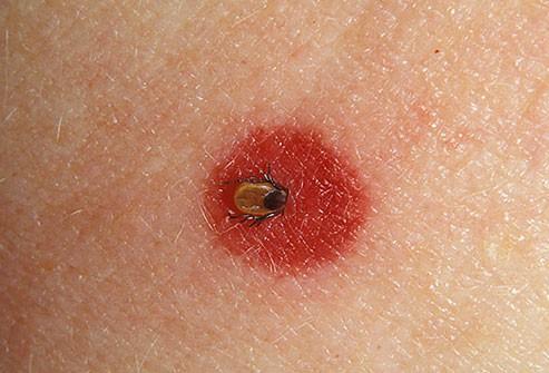 Lyme Disease More Prevalent than Previously Thought