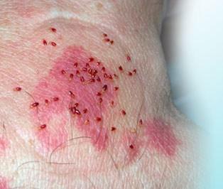 Image via Bed Bugs Treatment Site